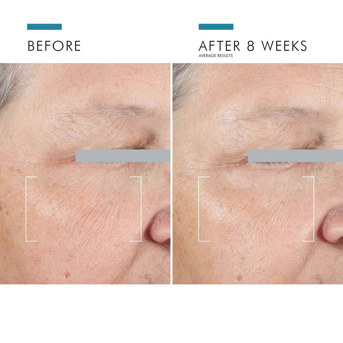 Before and after comparison of a person's cheek and under-eye area showing visible wrinkle reduction after 8 weeks, with text reading 'BEFORE' and 'AFTER 8 WEEKS' on a white background.